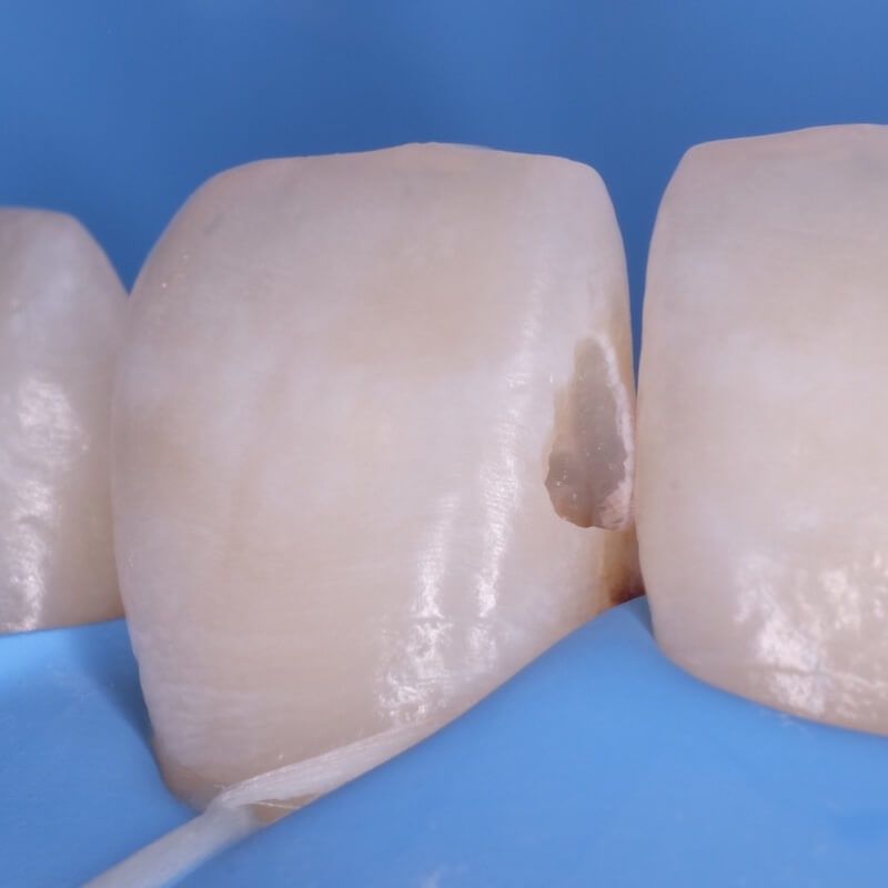 полость зуба после удаления кариеса