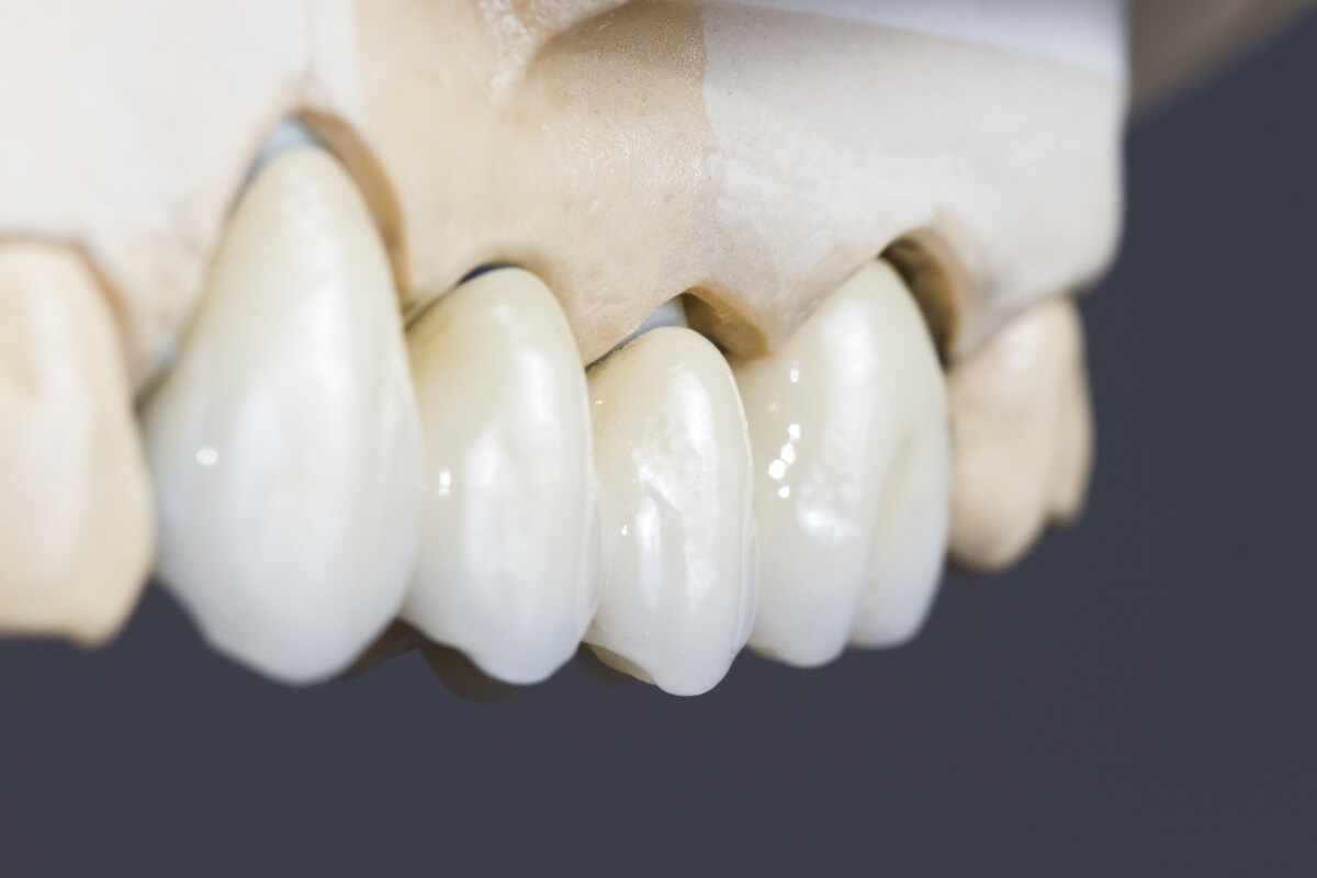 Металлокерамические коронки и мосты на модели повторяющей зубы пациента