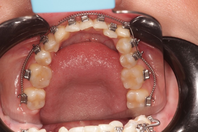 Фото зубов нижней челюсти пациента с установленными брекетами для исправления прикуса
