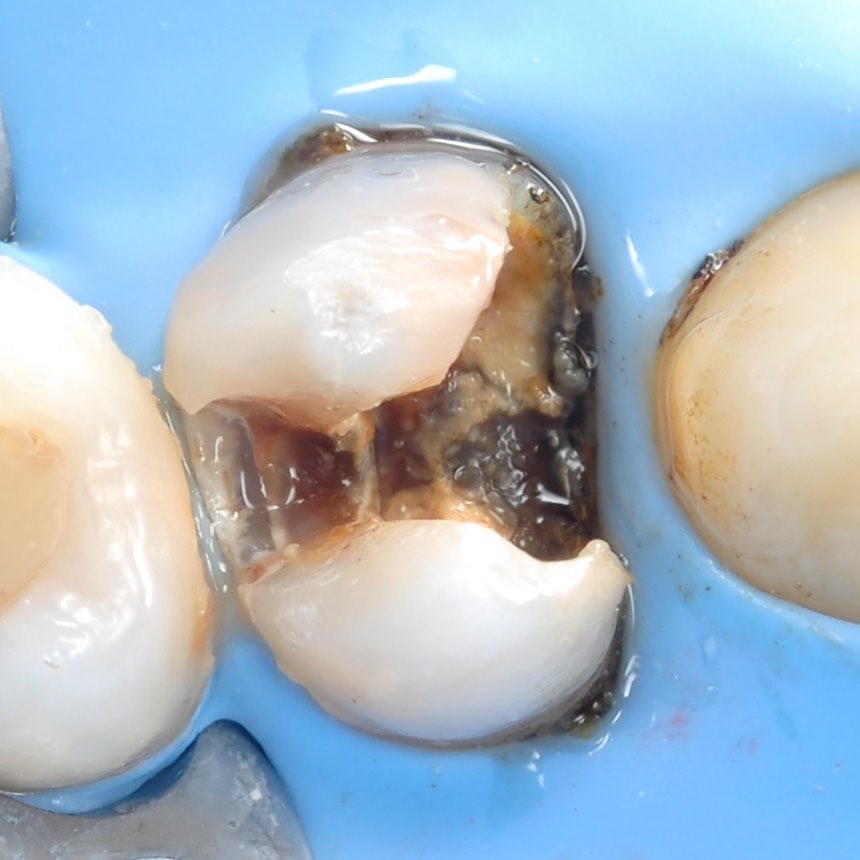 ткани зуба поражены инфекцией которые требуется убрать в процессе лечения пульпита