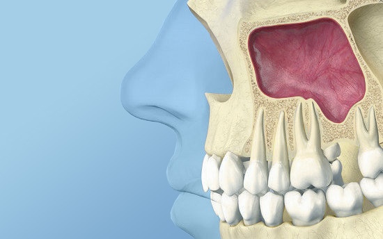 схема верхней челюсти пациента требующего синус лифтинг