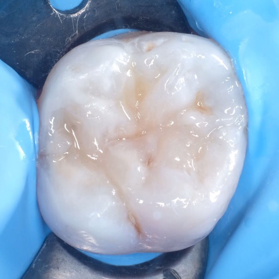 фото передних зубов до лечения кариеса в Ставрополе