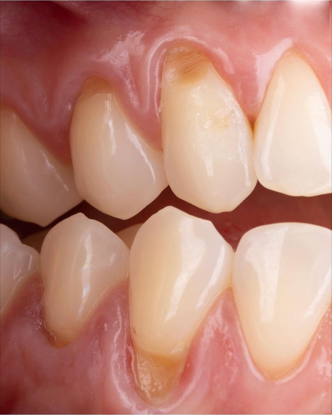 клиновидный дефект на зубах