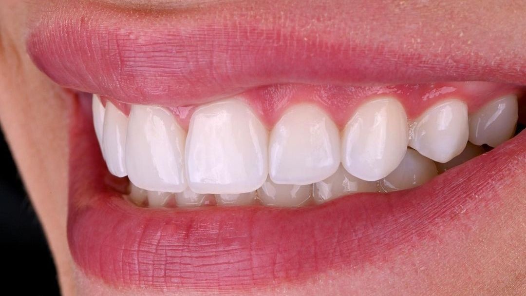 фото керамических виниров на зубах после протезирования