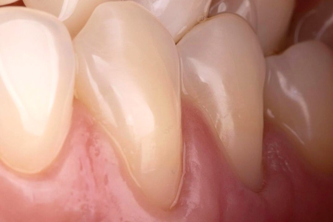 Пришеечная область зубов после реставрации