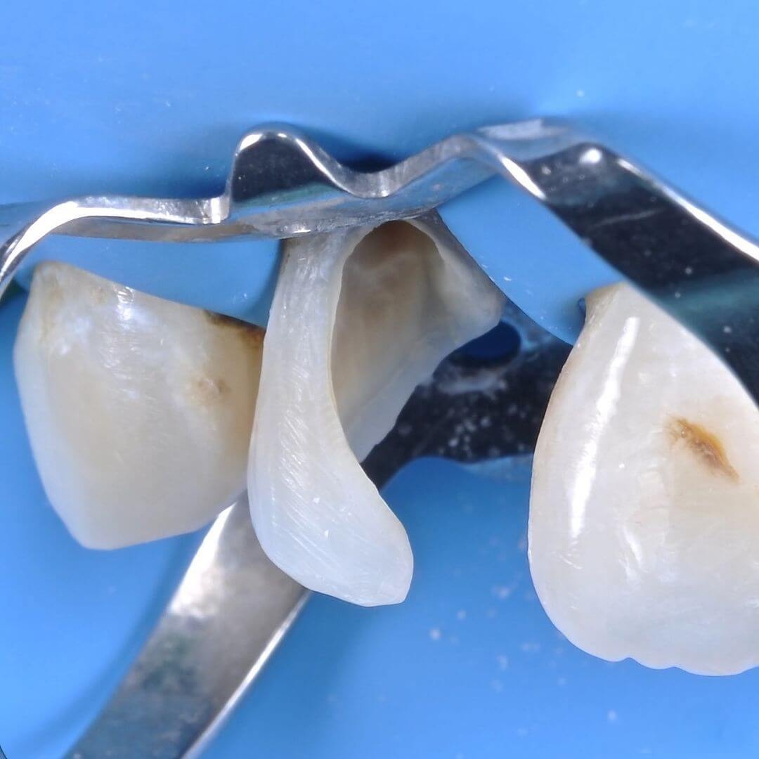 обломанный зуб в процессе восстановления