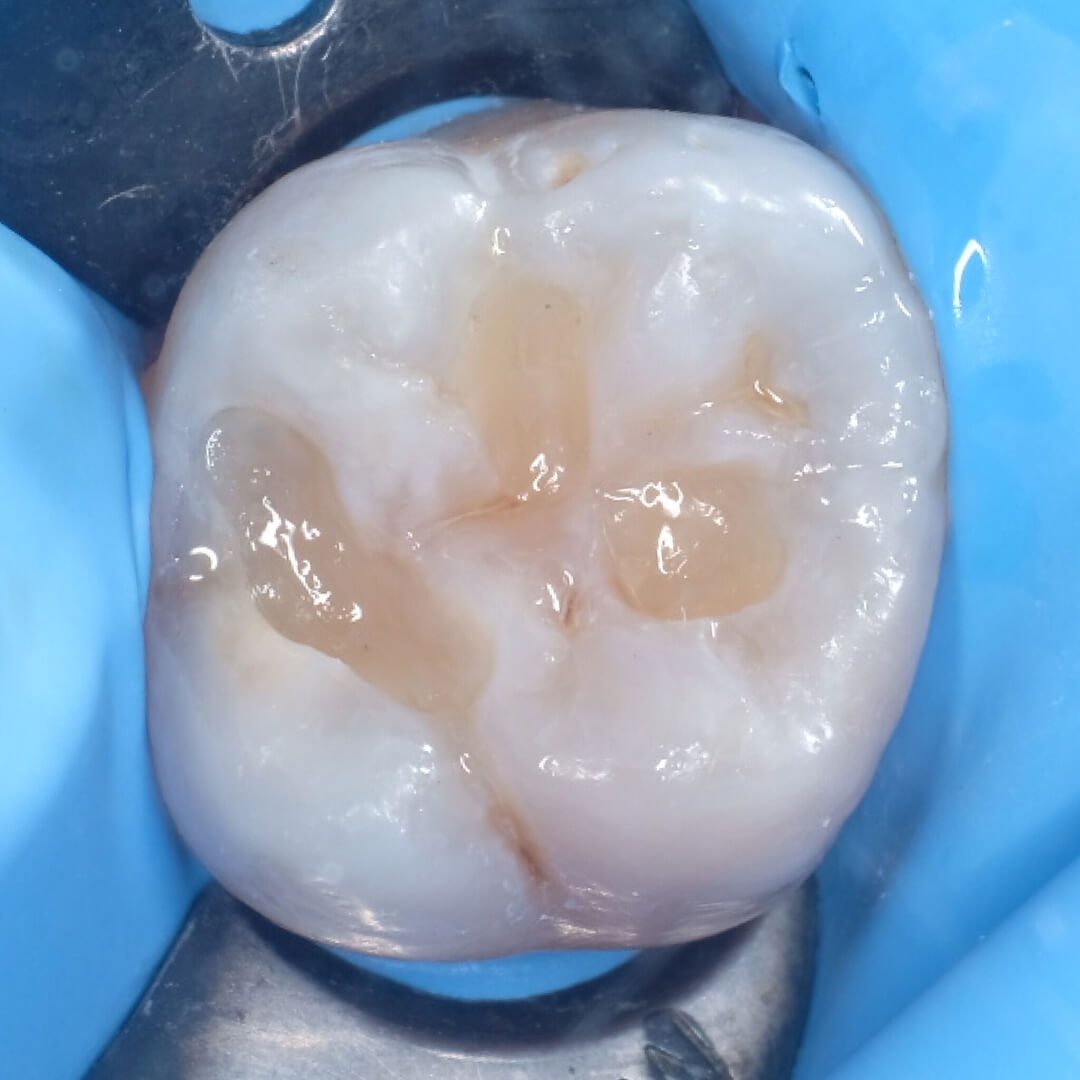 жевательный зуб после установки композитных пломб в процессе лечения кариеса