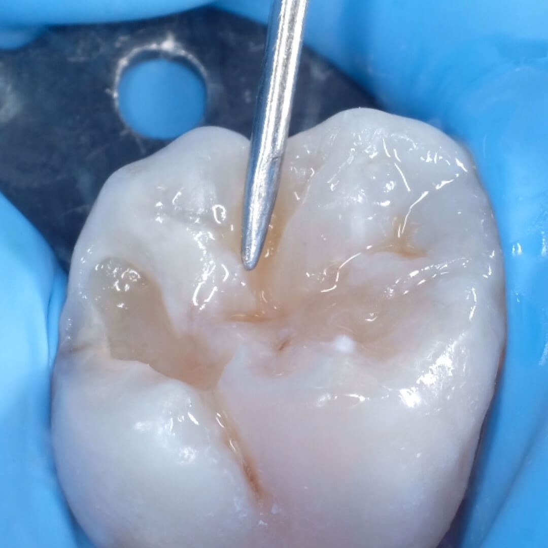 жевательный зуб после восстановления бугров в процессе лечения кариеса