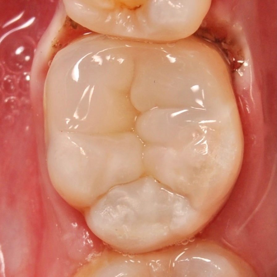 жевательный зуб после успешного лечения под микроскопом