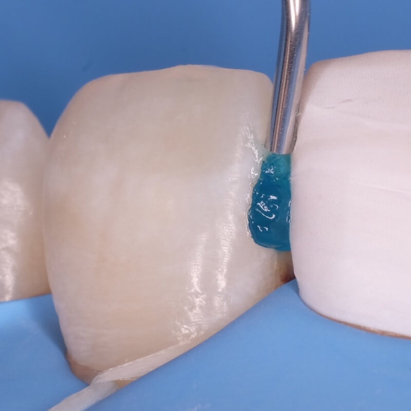 обработка полости зуба после удаления кариеса