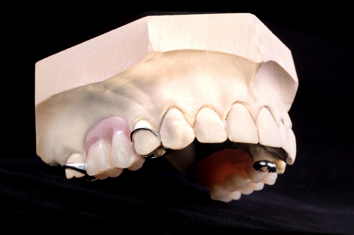 Съемный частичный протез жевательных зубов верхней челюсти