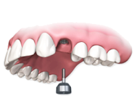 Установка формирователя десны на имплантат в стоматологии Стомион