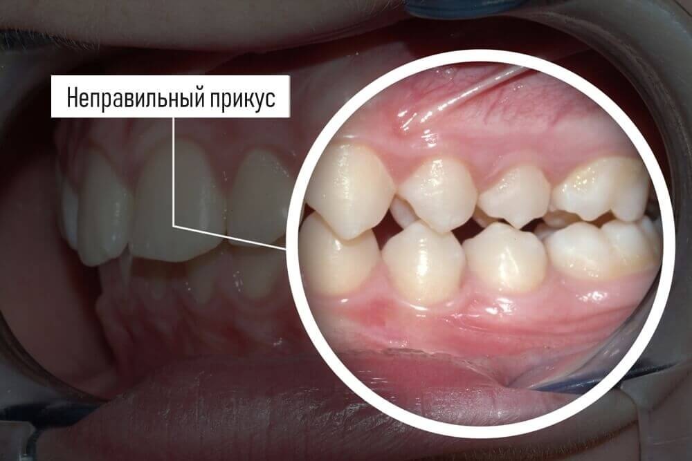 неправильный прикус - травматичное смыкание зубов