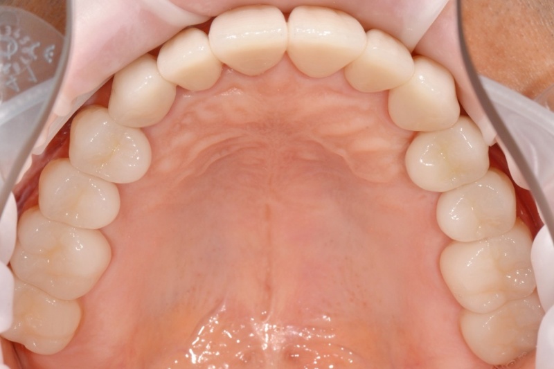 Фото зубов пациента после тотального протезирования зубов цикониевыми коронками