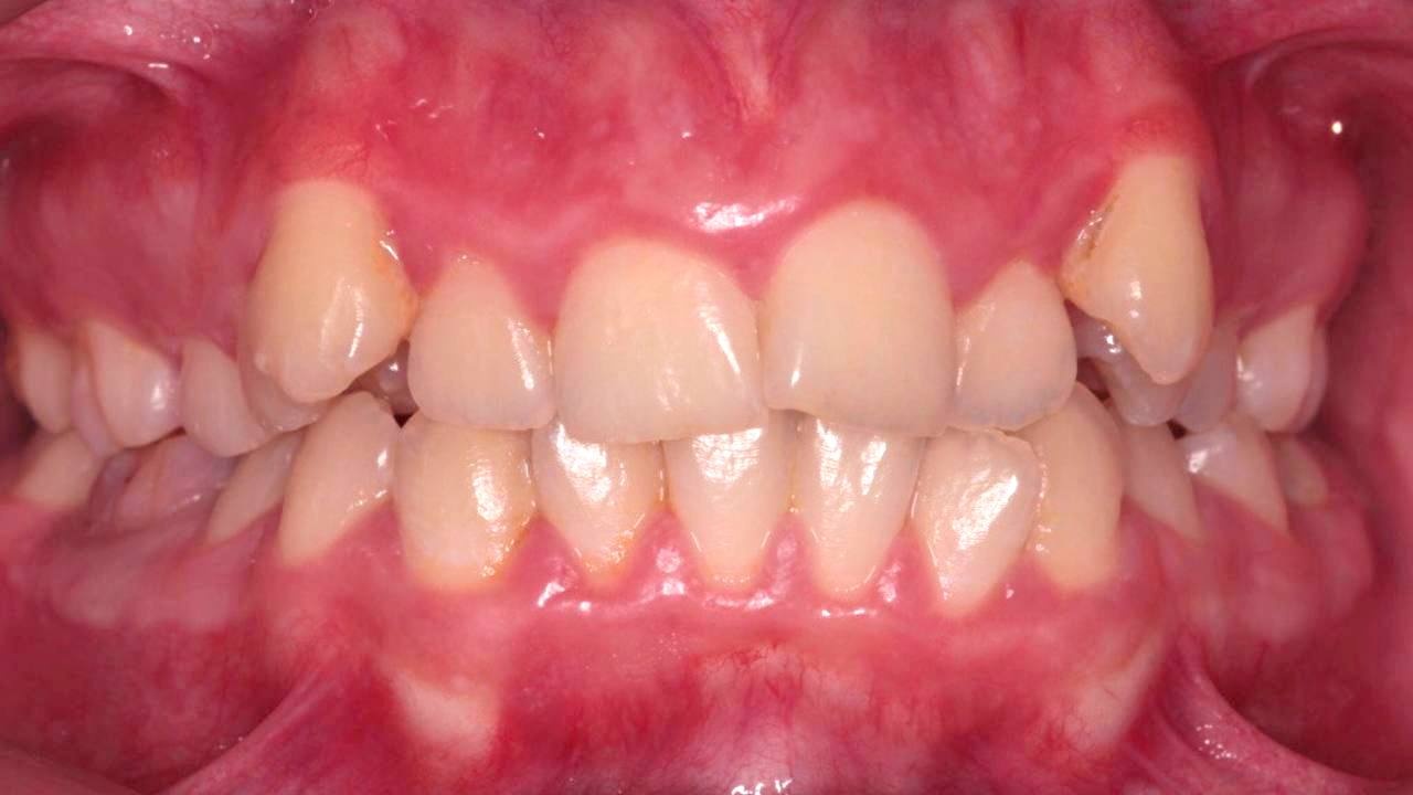 Фото зубов юного пациента до исправления прикуса