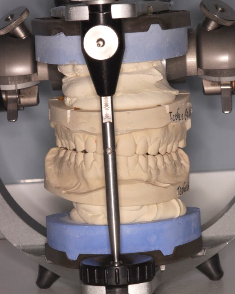 Модель челюстей пациента для диагностики и планирования движения зубов во время исправления прикуса