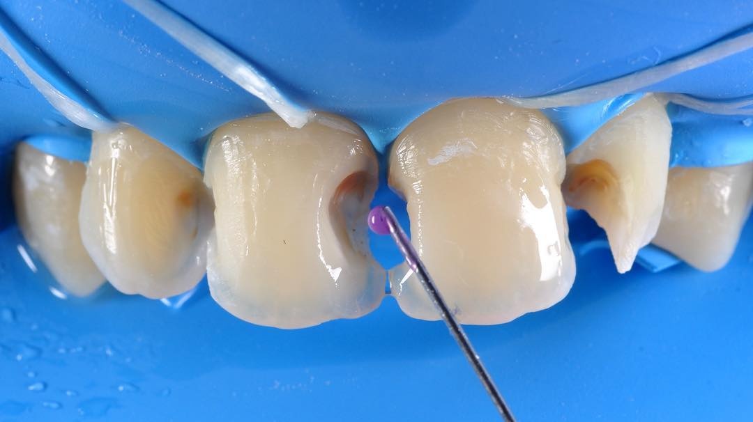 Обработанные передние зубы в процессе реставрации 
