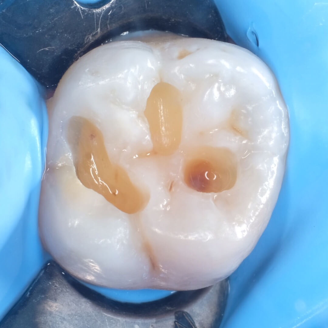 жевательный зуб с полостями очищенными от кариеса