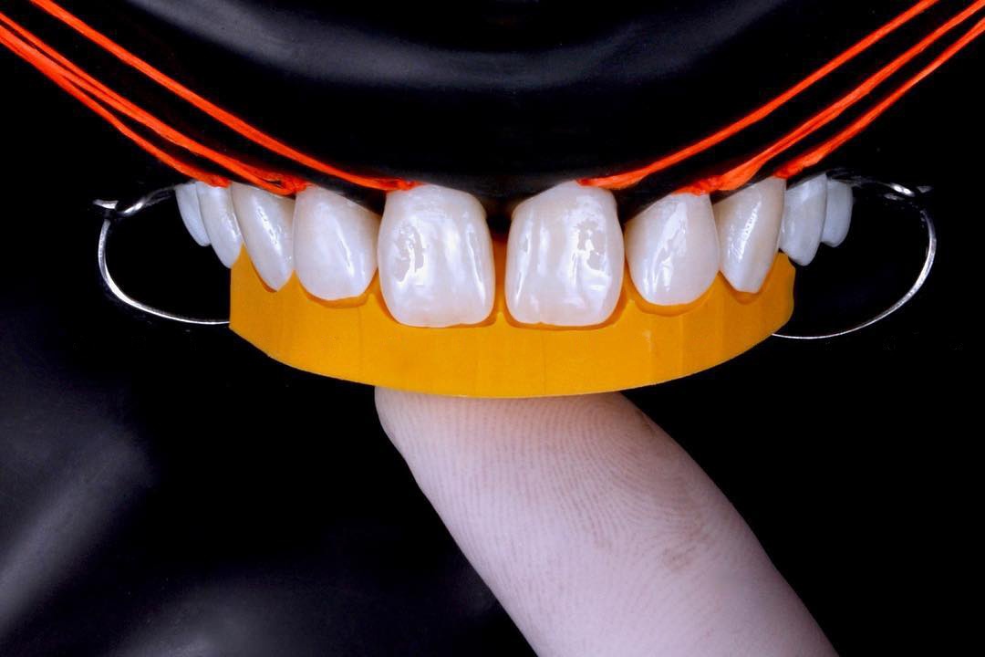 Стоимость установки 6-ти керамических виниров на передние зубы под ключ