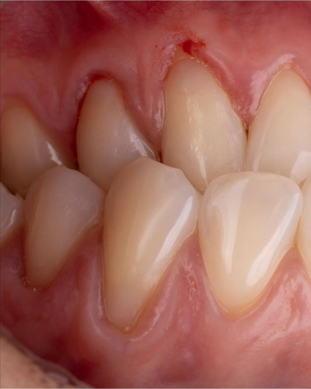 отреставрированные передние зубы с устраненным клиновидным дефектом