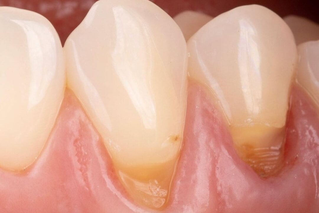 прешеечная область зубов до реставрации
