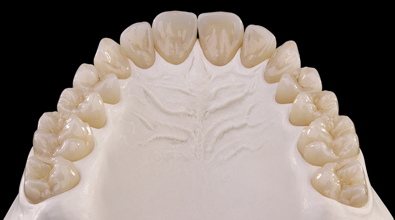 Модель зубов пациента с размещенными на ней циркониевыми коронками иллюстрирует стоимость тотального протезирования зубов в Ставрополе под ключ