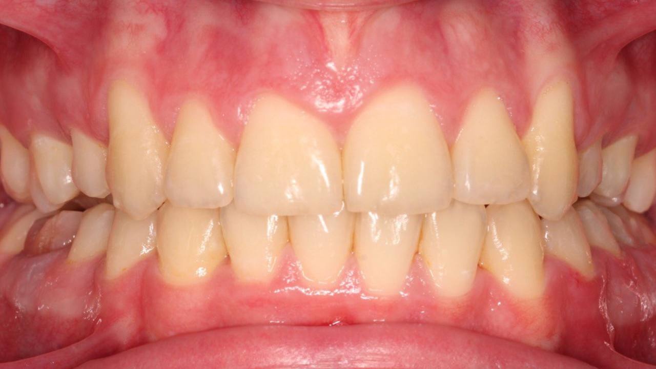 Фото зубов юного пациента после исправления прикуса