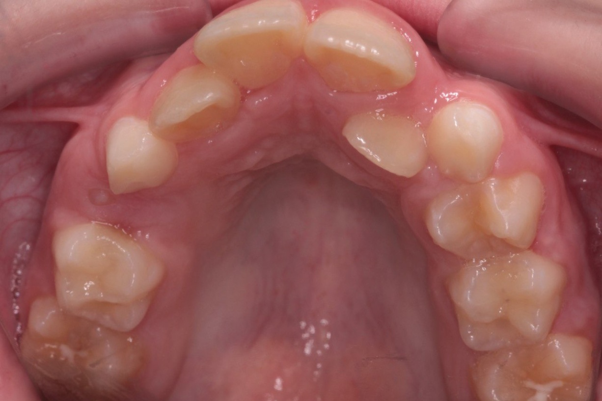 Фото скученных зубов подростка требующих исправления прикуса и установки ортодонтического аппарата
