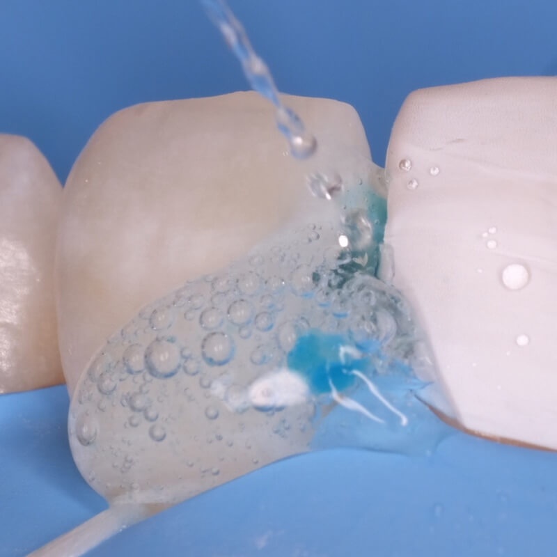 промывка полости зуба после удаления кариеса