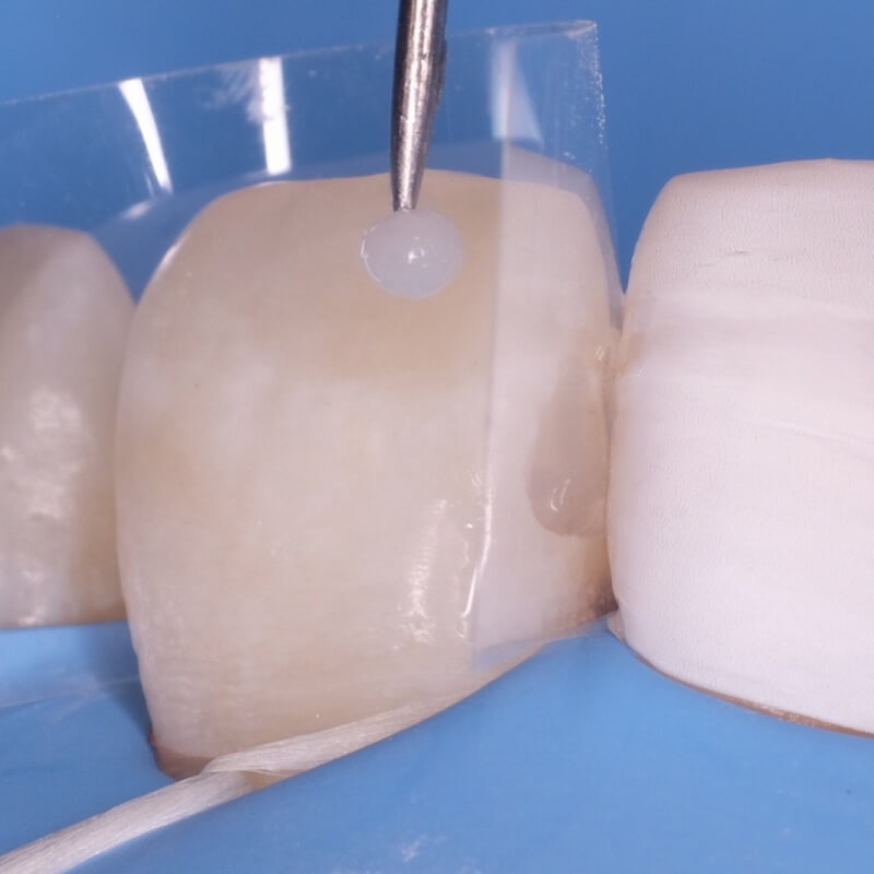 пломбирование полости зуба во время лечения кариеса