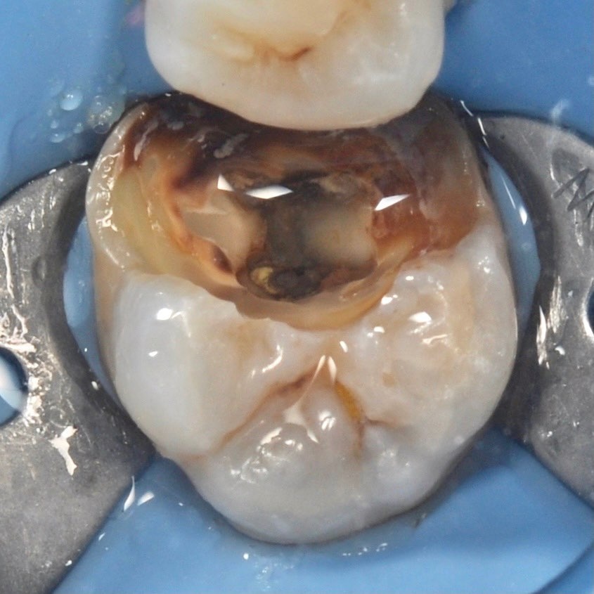жевательный зуб с инфекцией в каналах до лечения под микроскопом