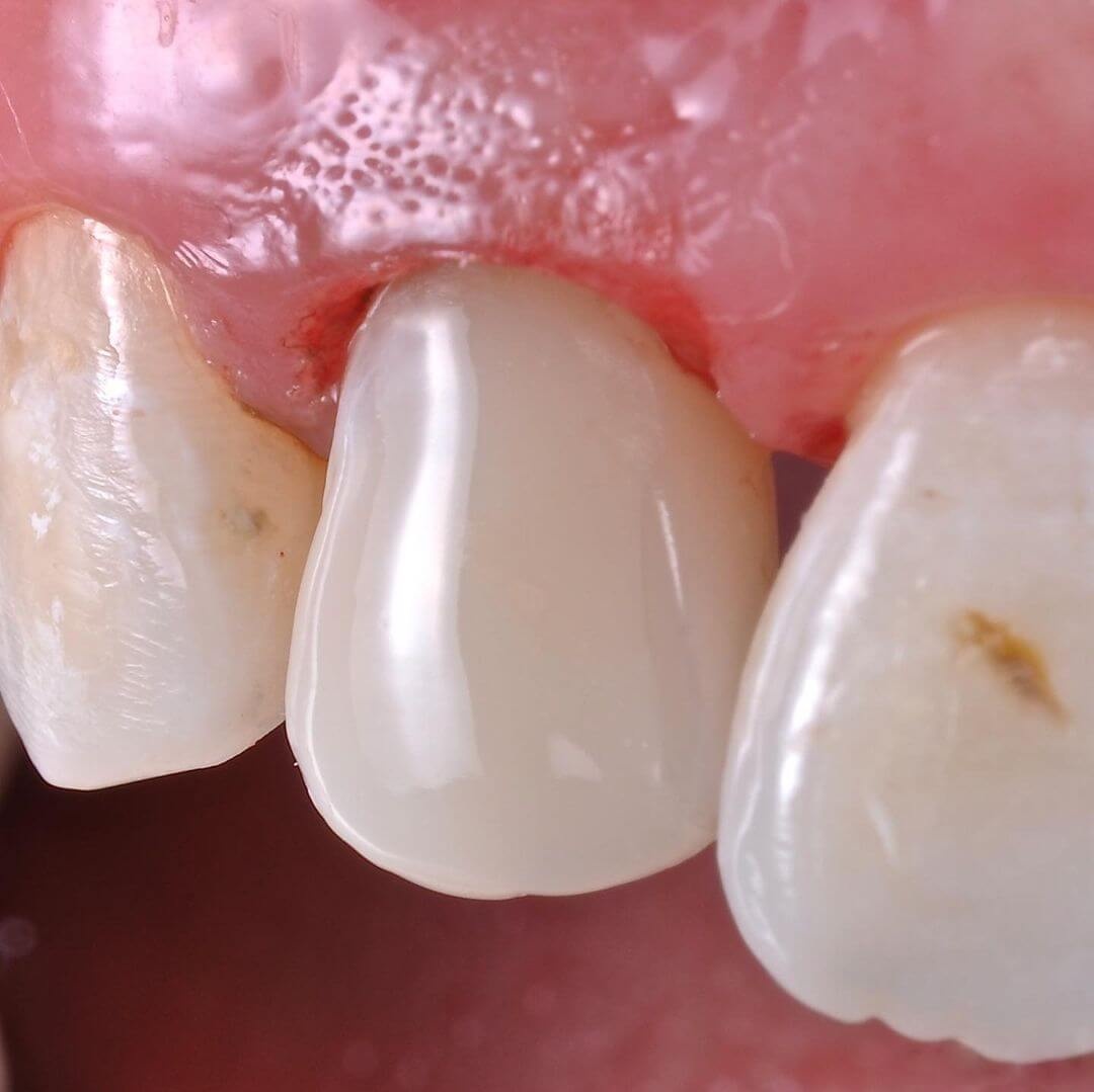 восстановленный композитными материалами обломанный зуб