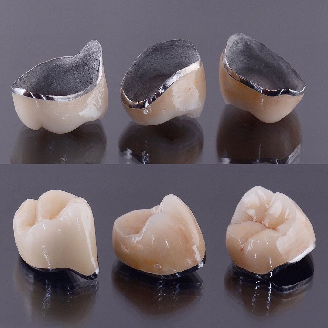 Фотографии металлокерамических коронок до установки на зубы