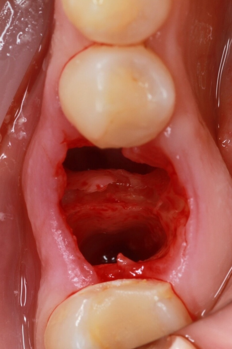 удаление зуба с сохранением перегородки для установки имплантата