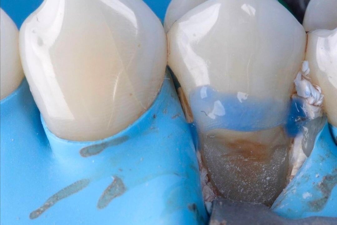 изоляция зубов до проведения эстетической реставрации
