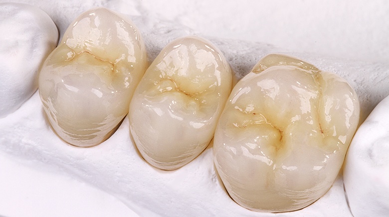 Мост из диоксида циркония для протезирования жевательных зубов