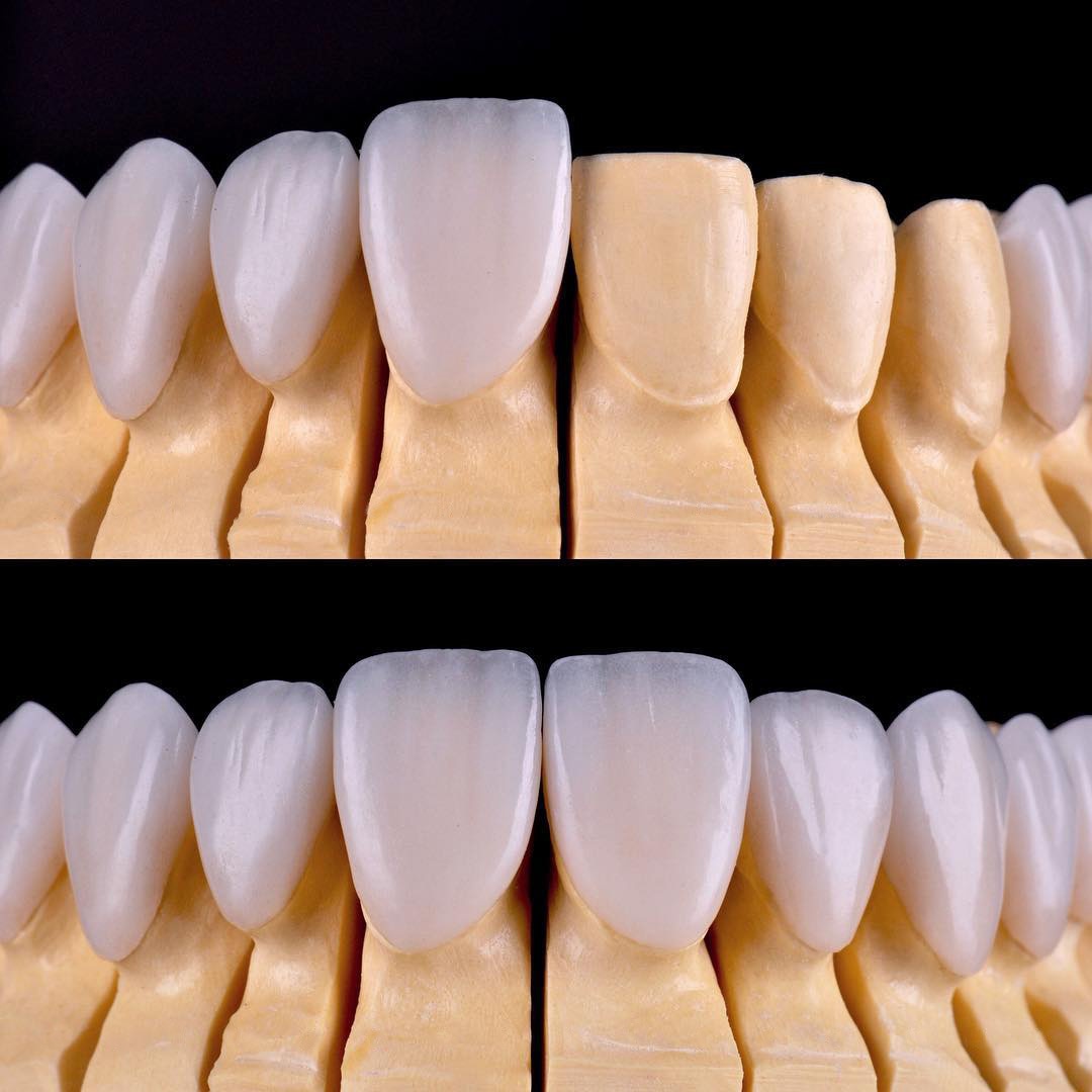 Керамические виниры для зубов на модели