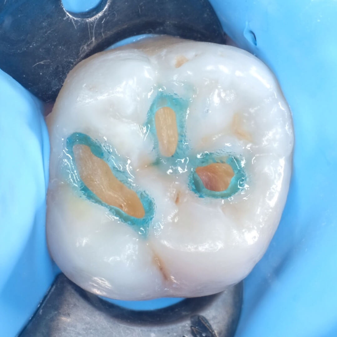 жевательный зуб обрабатывается в процессе лечения кариеса