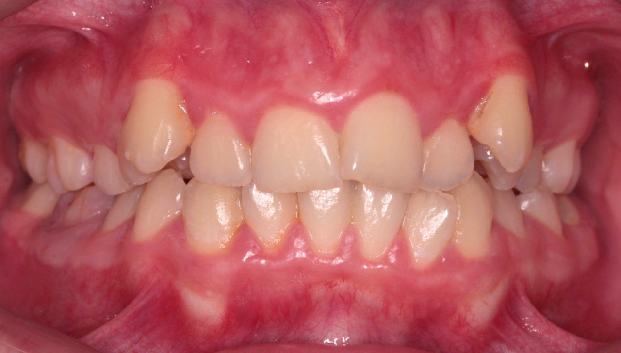 Сложный пример до и после исправления прикуса ортодонтом стоматологии Стомион в Ставрополе