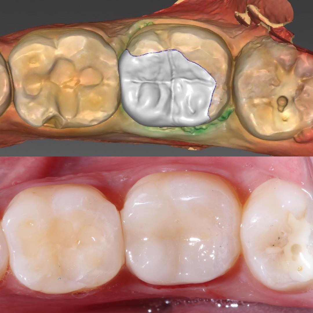 Керамическая вкладка выполненная по протоколам цифровой стоматологии