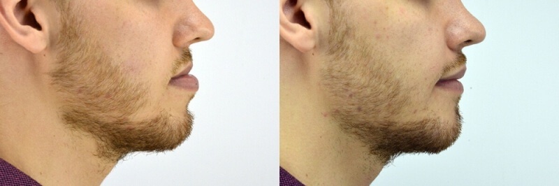 Фото с боку положения челюсти до и после коррекции прикуса металлическими брекетами
