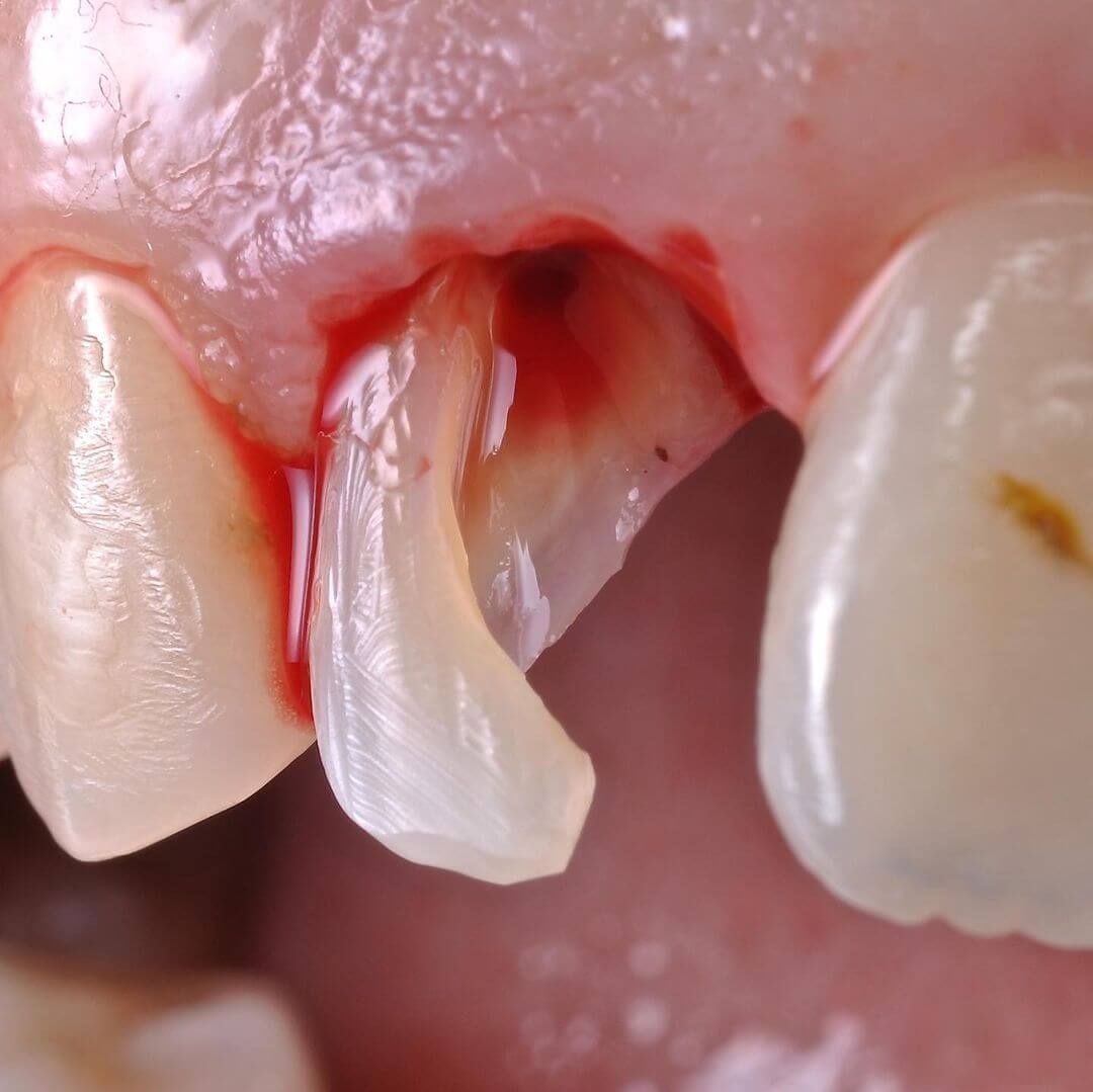 обломанный зуб