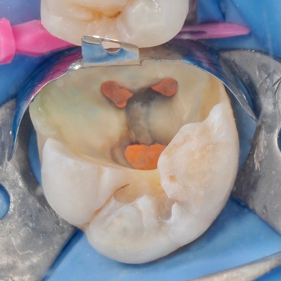 жевательный зуб с запломбированными каналами в процессе лечения под микроскопом
