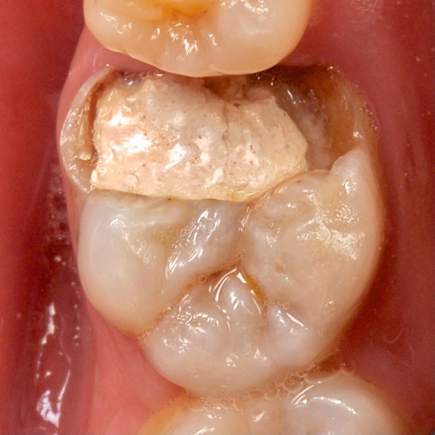 жевательный зуб требующий лечения под микроскопом